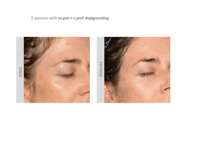 Mens Acupuncture and facial