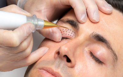 Plasma Eye Lift Treatments