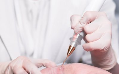 Nlite Laser – Acne, Open Pores, Rosacea, Veins, Wrinkles & Warts