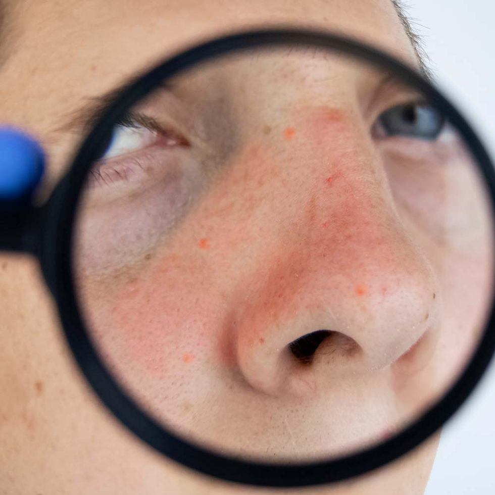 Nlite Rosacea Healing Emporium Treatment Clinic Marylebone