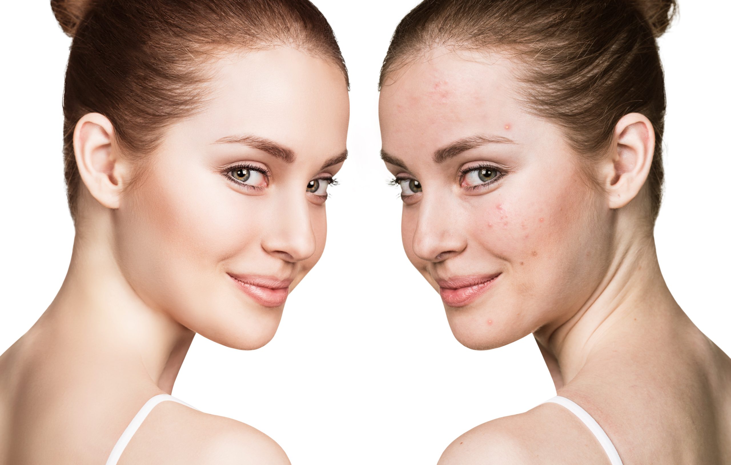 acne before and after treatment