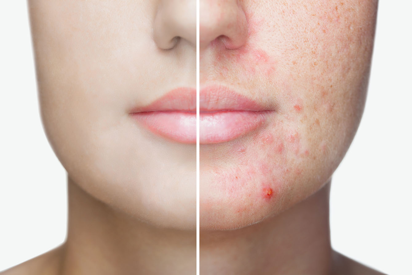 acne before and after treatments