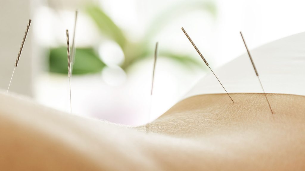 acupuncture for back pain