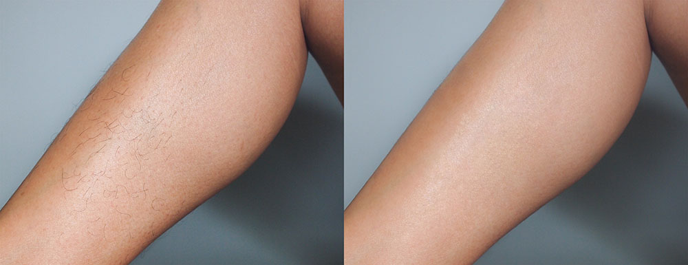 hair removal before after