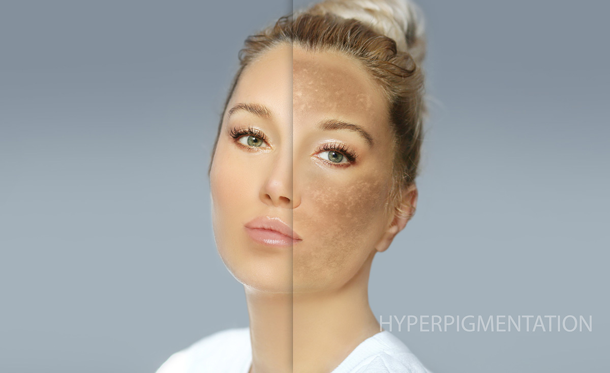 treating hyper pigmentation