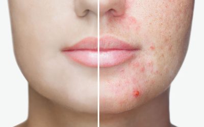 Can Nlite Laser Really Heal Acne?