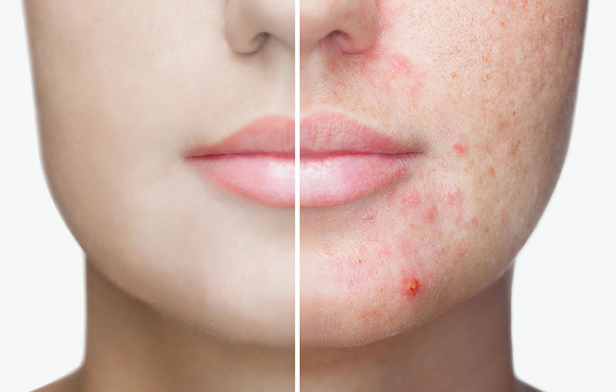 face-acne-treatments face acne treatments near me