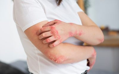 Psoriasis Skin Condition