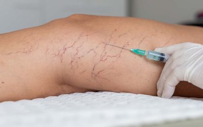 Spider Veins Be Gone!