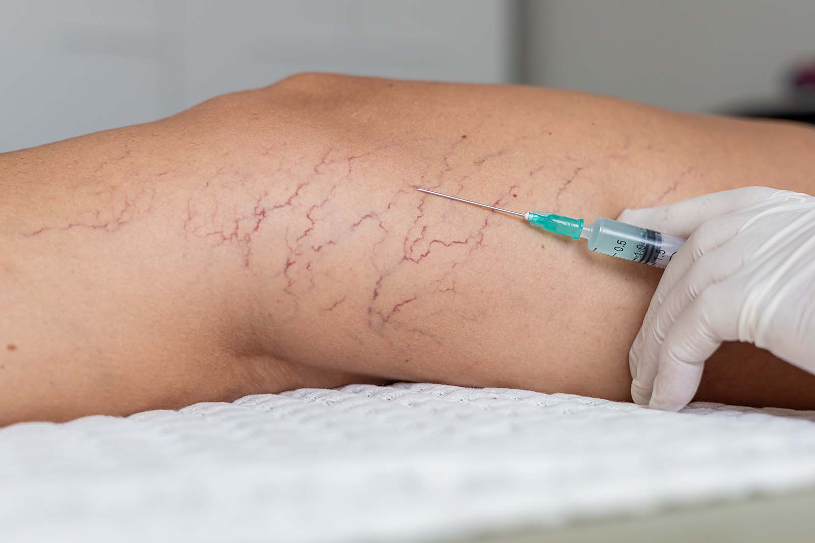 Sclerotherapy Vein Removal Injections Sclerotherapy Vein Removal Injections