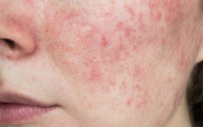 What Is Rosacea & How To Soothe Your Skin