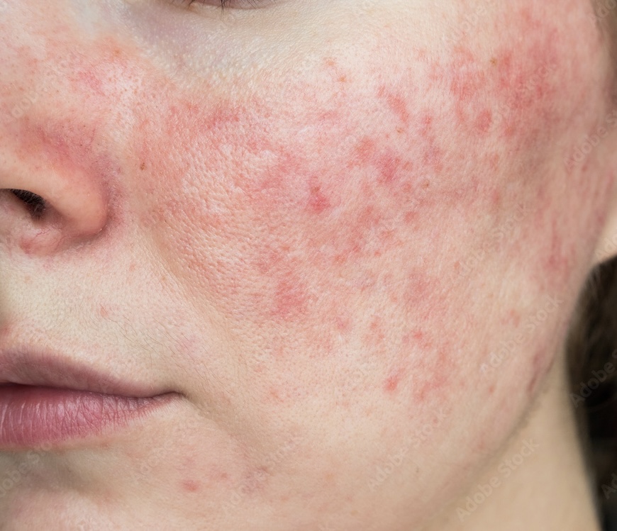 rosacea cheek