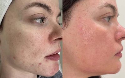 Acne Skin Treatment Case Study