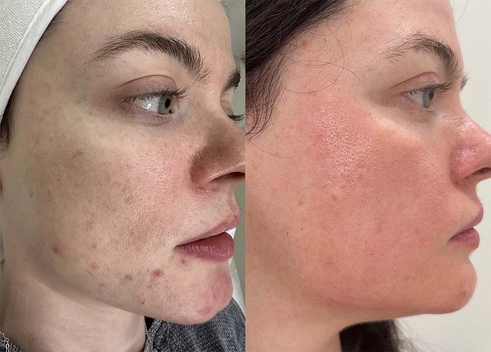Acne Skin Treatment