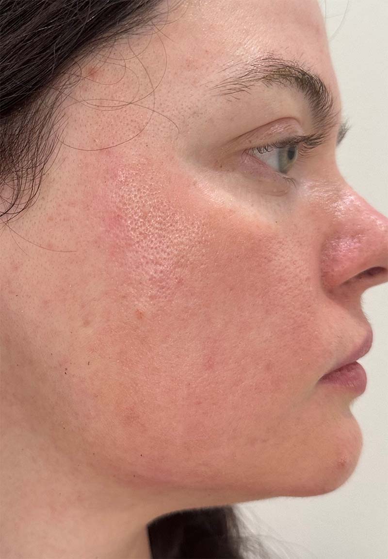 importance of sunscreen