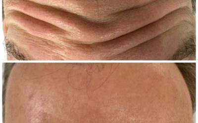 Anti-Wrinkle Upper Face Case Study