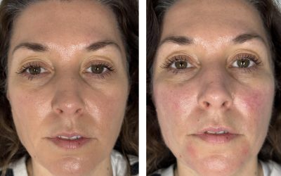 Skin Rejuvenation Case Study