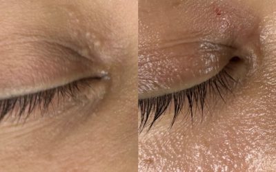 Milia Removal – Upper Eye Lid Case Study