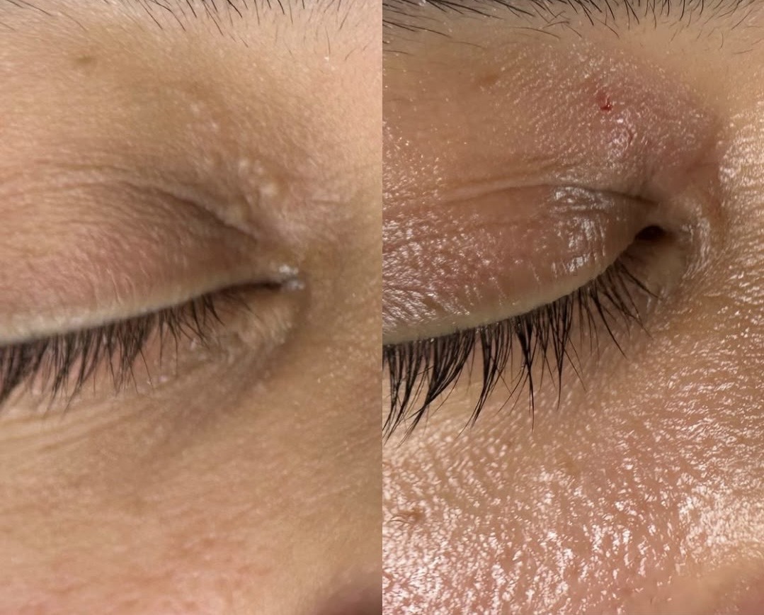 milia removal upper eye lid 1