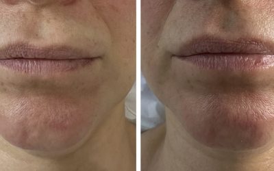 Unsymmetrical Lip Volume Case Study