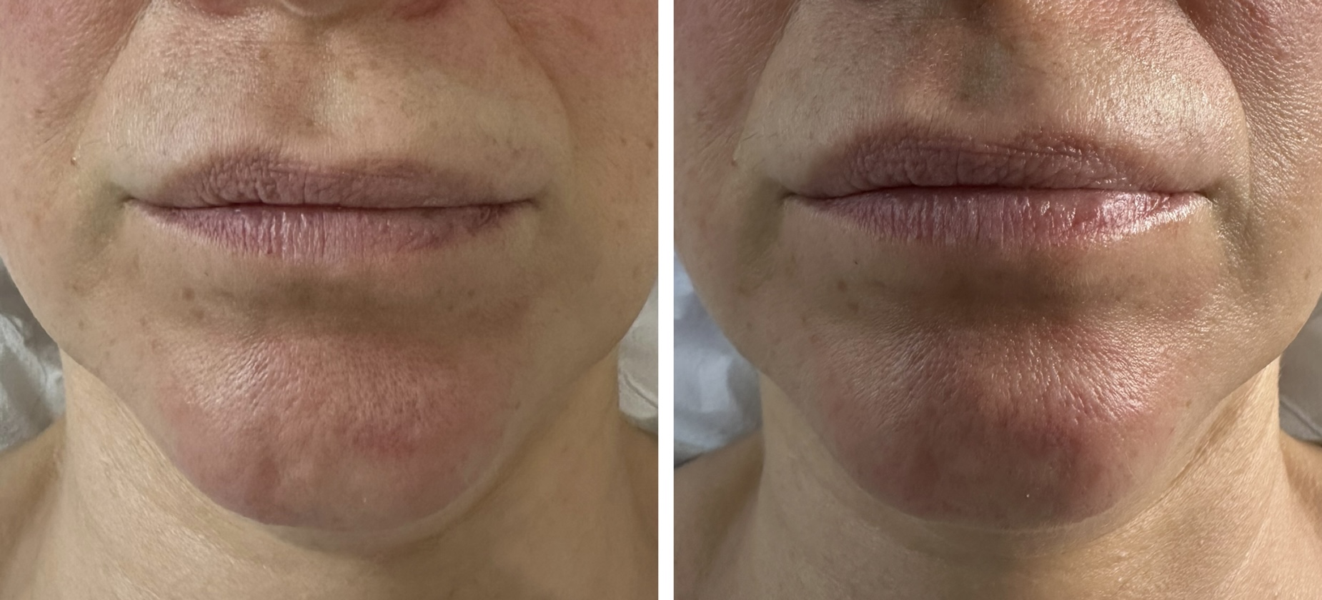 seventy hyal lip Tanira